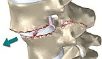 Dấu hiệu bệnh cột sống mất vững