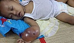Bé Gia Huy bị ung thư xương cần được giúp đỡ