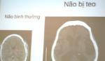 Rượu phá hủy não, tim con người như thế nào