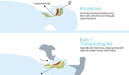 Làm gì để cứu người bị chấn thương gây tuột lưỡi?
