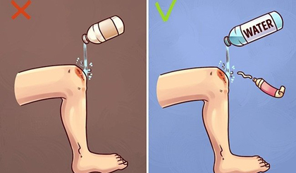 Rửa vết thương đúng cách là rửa bằng nước sạch hoặc nước đun sôi, rồi bôi thuốc mỡ lên vết thương.