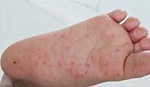 Nuốt đau, chảy nước dãi là dấu hiệu sớm của bệnh tay chân miệng