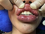 Liên tiếp các ca tai biến thẩm mỹ do tiêm chất làm đầy môi, mắt