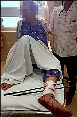 Cụ bà 66 tuổi bị 2 thanh sắt đâm xuyên chân