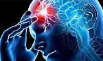 Phương pháp điều trị tiềm năng cho chứng mất trí và đột quỵ