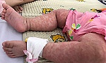 Cảnh báo bệnh sởi đang có chiều hướng gia tăng mạnh và sớm