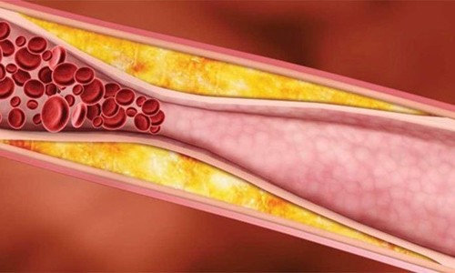 Máu nhiễm mỡ còn được gọi với tên gọi khác là rối loạn chuyển hóa lipid máu hay mỡ máu cao.