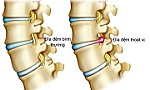 Đắp thuốc, nắn xương, bấm huyệt không chữa được thoát vị đĩa đệm