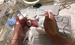 Kỳ tích em bé sinh non cân nặng bằng củ hành tây được xuất viện