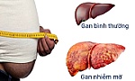 Gan nhiễm mỡ: Nguyên nhân, triệu chứng và cách điều trị