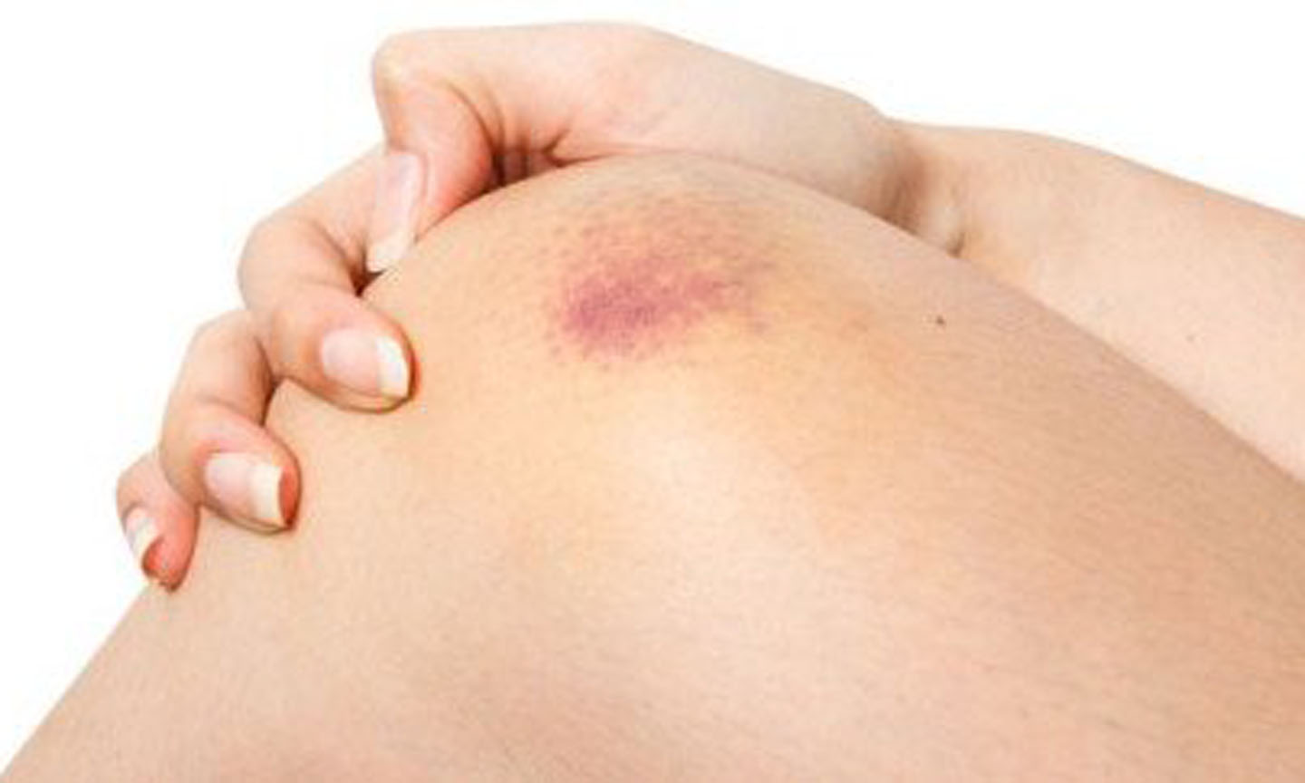 Vết bầm tím xuất hiện khi mạch máu bị tổn thương. (Ảnh: Davidwolfe).