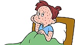Dấu hiệu và cách chăm sóc bệnh nhân bị thủy đậu