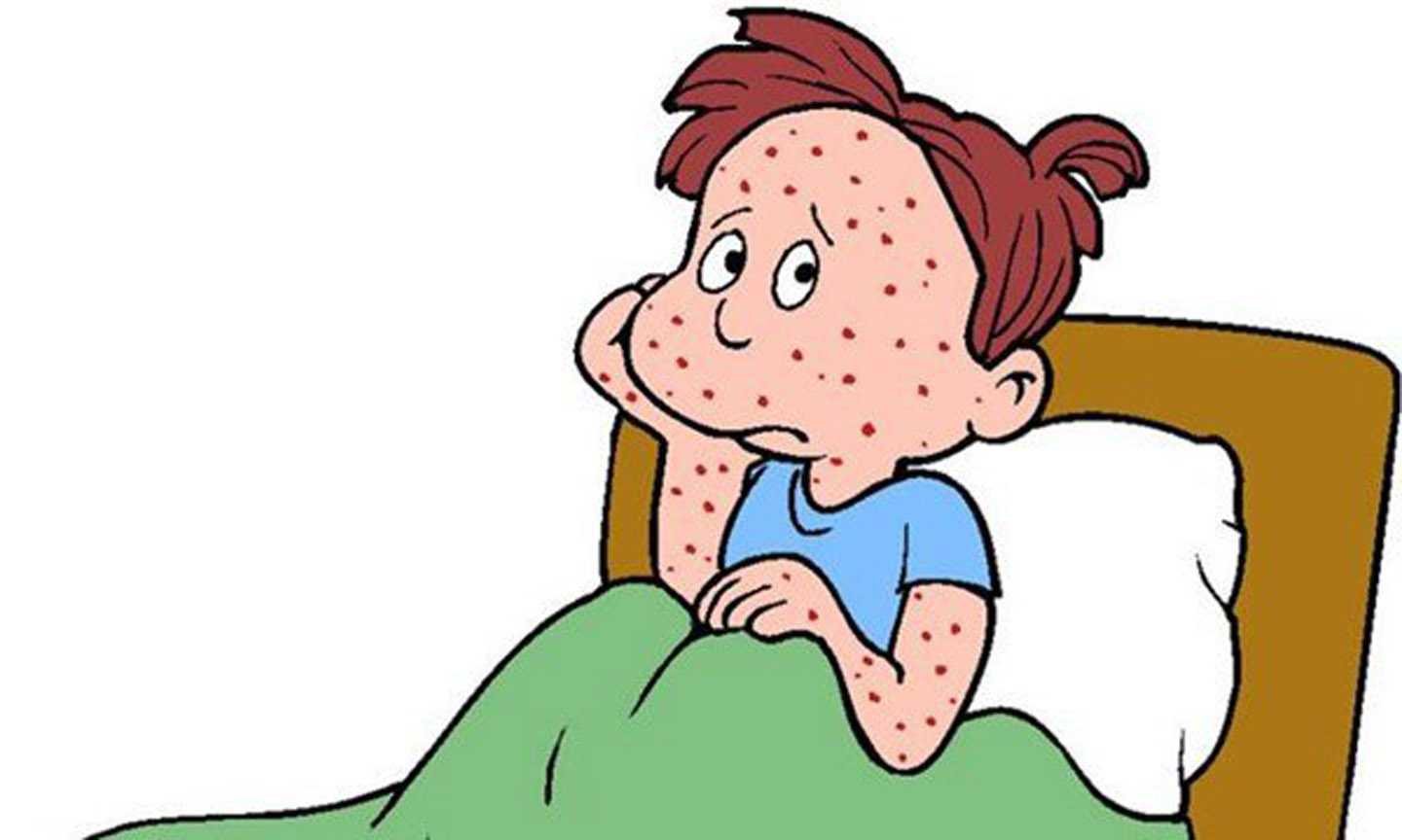 Thủy đậu là một bệnh lành tính nhưng cần được phát hiện sớm và chăm sóc chu đáo nếu không biến chứng sẽ rất nguy hiểm.