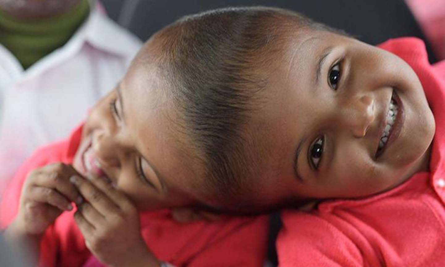 Hai bé song sinh dính liền đầu, ảnh chụp ngày 5/1/2019. (Nguồn: AFP)
