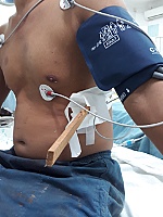 Cấp cứu thành công ca bị thanh gỗ đâm thấu ngực