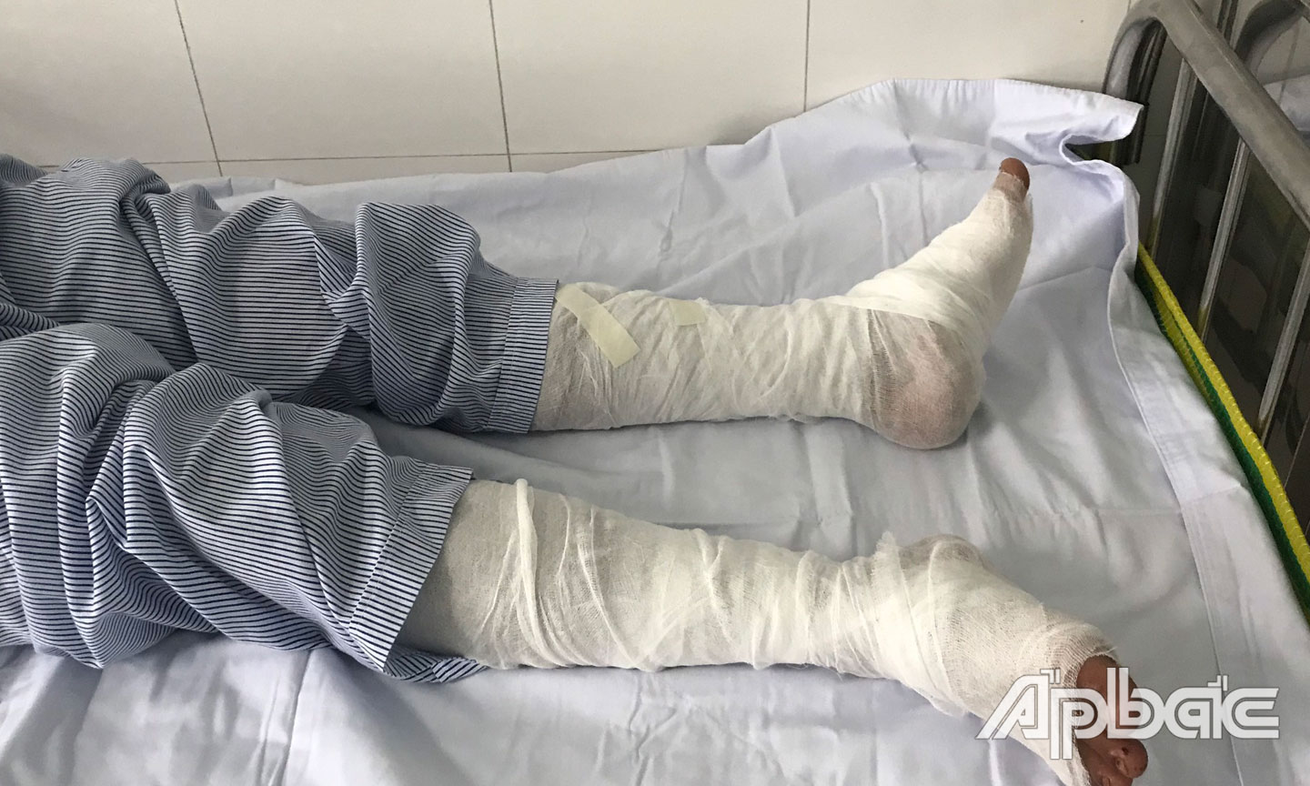 Các nạn nhân đa phần đều phỏng ở phần chân.