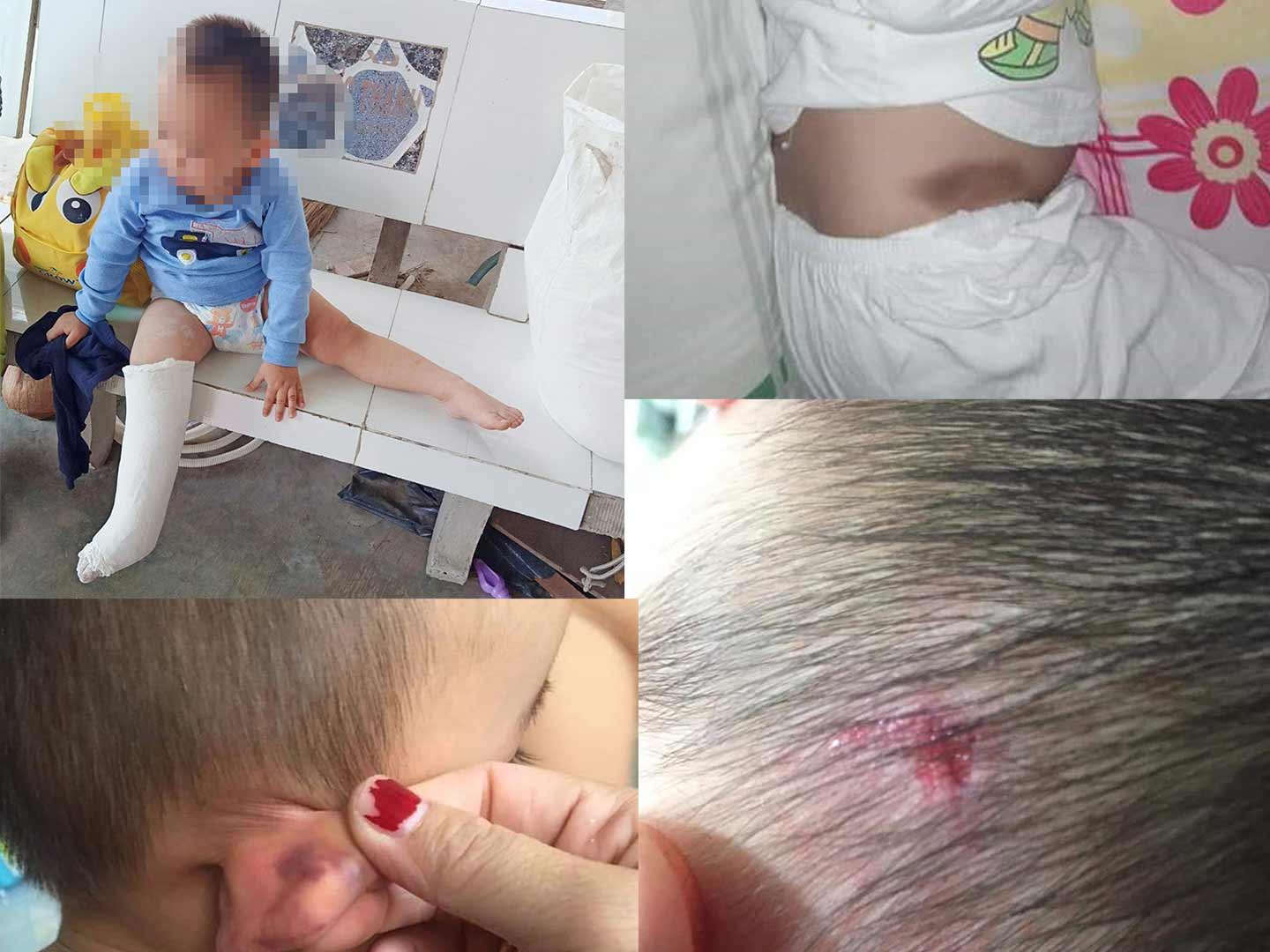 Một số hình ảnh bé Bảo trước đây bị trầy xước khi đi học về và hình ảnh bé phải băng bột trước đó.