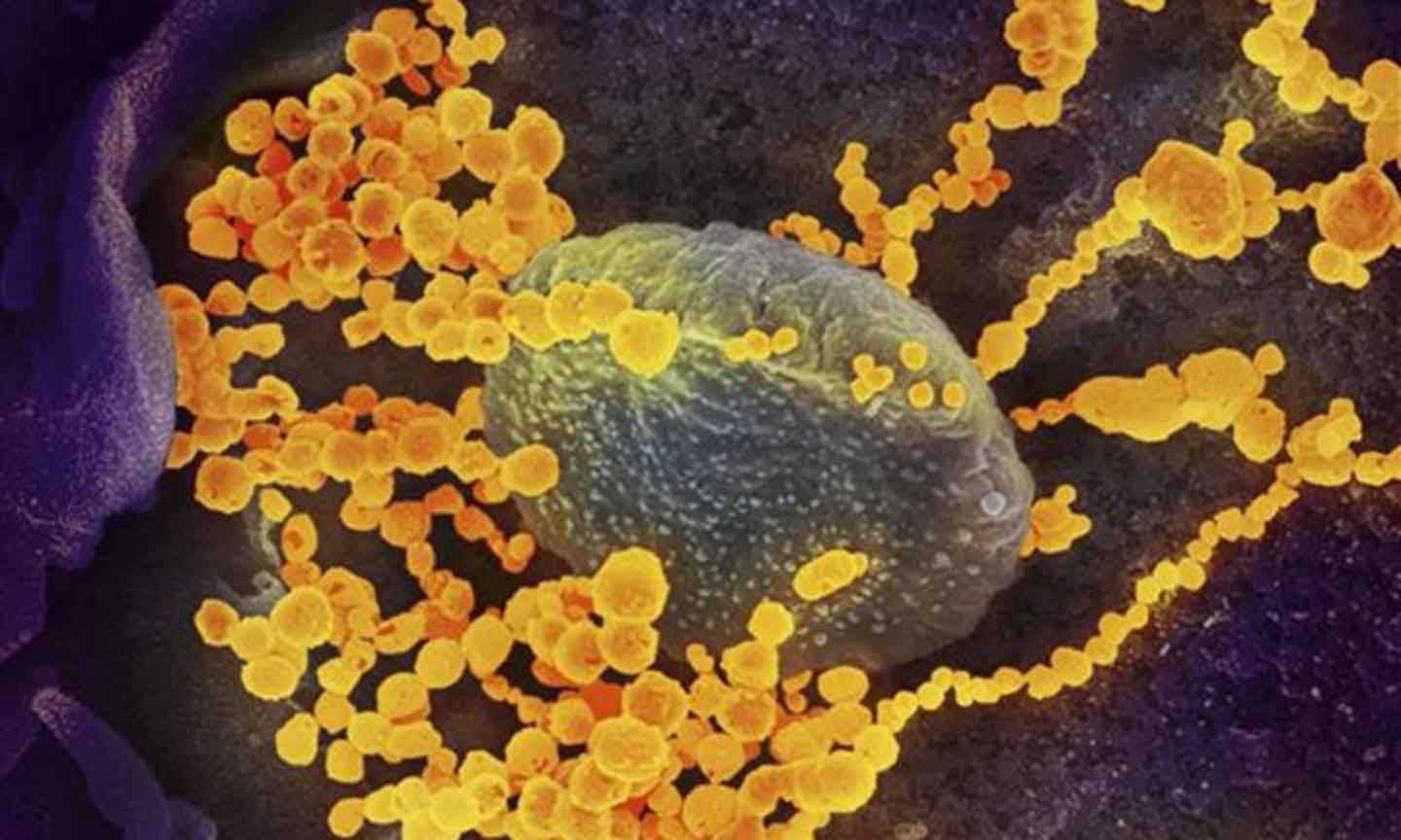 Hình ảnh virus SARS-CoV-2 (màu vàng) nổi lên bề mặt tế bào người. (Ảnh: AFP/TTXVN)