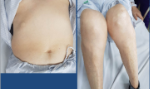 Tình trạng lạm dụng corticoid có xu hướng tăng lên
