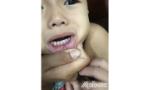 Bỗng nhiên có cục bướu trên môi, là bệnh gì?