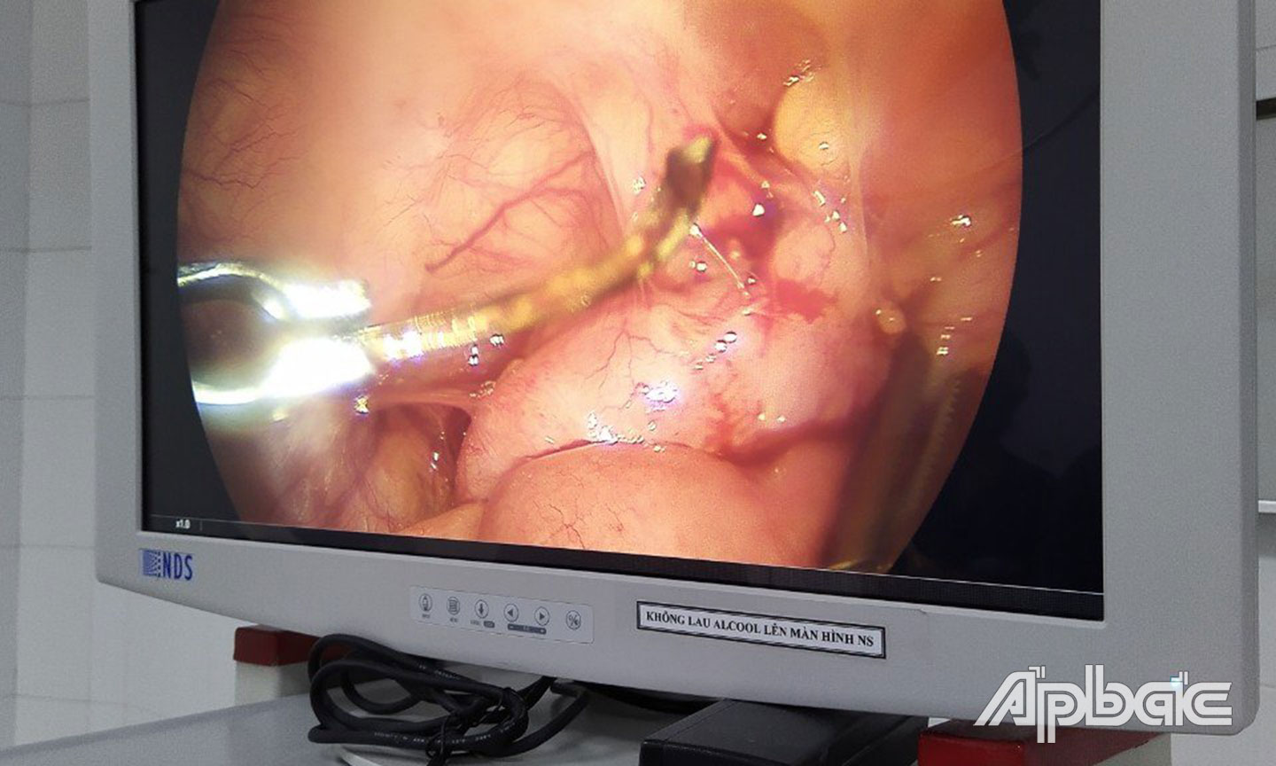 xương 3cm nằm trong ruột bệnh nhân.