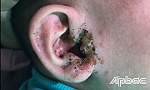 Đắp lá cây lên vành tai, coi chừng nhiễm trùng nặng
