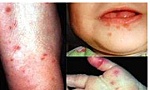 Cảnh giác với bệnh tay chân miệng