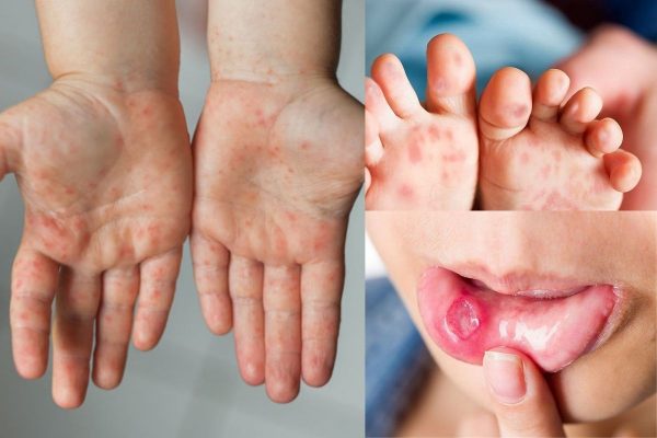 Đến nay cả nước đã có 5.545 ca mắc tay chân miệng, 01 trường hợp tử vong, Bộ Y tế dự báo dịch bệnh tay chân miệng có xu hướng gia tăng trong thời gian tới đây.