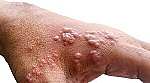 Ba đường lây nhiễm bệnh đậu mùa khỉ từ người sang người
