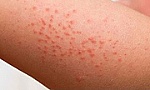Cảnh giác bệnh sốt xuất huyết giả dạng viêm hô hấp trên ở trẻ