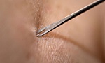 Đã tiêm ngừa đậu mùa từ nhỏ, có ngừa được đậu mùa khỉ?