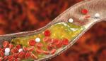 Các phát hiện mới liên quan tới lượng cholesterol trong máu