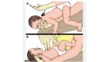 Có thể cứu sống trẻ bị dị vật đường thở chỉ với đôi bàn tay