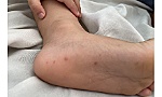 TP Hồ Chí Minh: Thành lập tổ chuyên gia khi bệnh tay chân miệng có biến chủng nguy hiểm