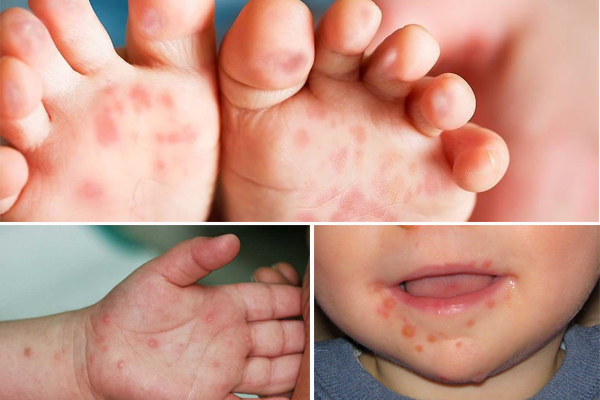 Số trẻ em mắc bệnh tay chân miệng tại TP.HCM có dấu hiệu gia tăng nhanh trong các tuần gần đây. Ảnh minh họa