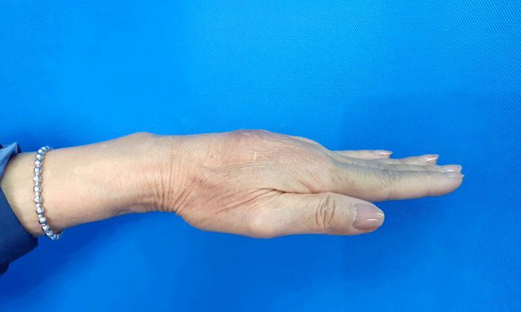 Biến chứng u hạt khi tiêm filler tay.