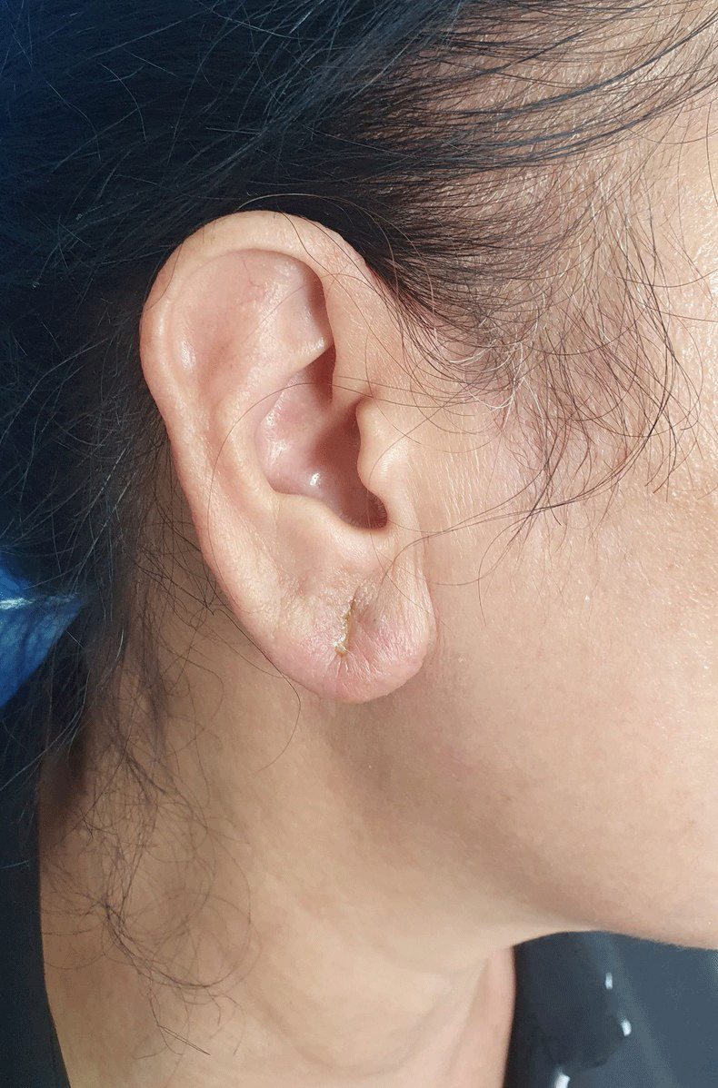 Biến chứng nhiễm trùng sau tiêm filler tai tài lộc.