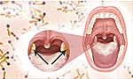 Ba người tử vong do bạch hầu, Bộ Y tế yêu cầu tập huấn, phát hiện sớm ca bệnh