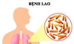 Thủ tướng chỉ đạo tăng cường công tác phòng, chống bệnh Lao