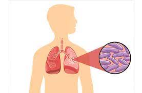 Tăng cường các giải pháp nhằm chấm dứt bệnh Lao vào năm 2030.