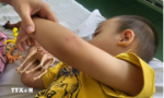 Cảnh báo gia tăng bệnh tay chân miệng tại khu vực phía Nam