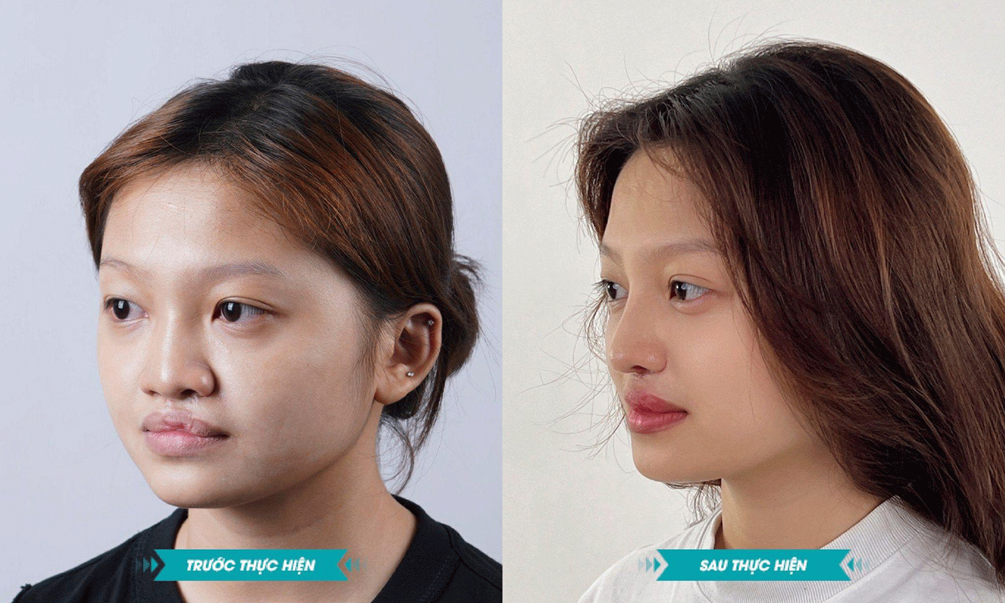 Sự thay đổi ngoạn mục của bạn Thảo Vân sau khi phẫu thuật sửa mũi môi dị tật.