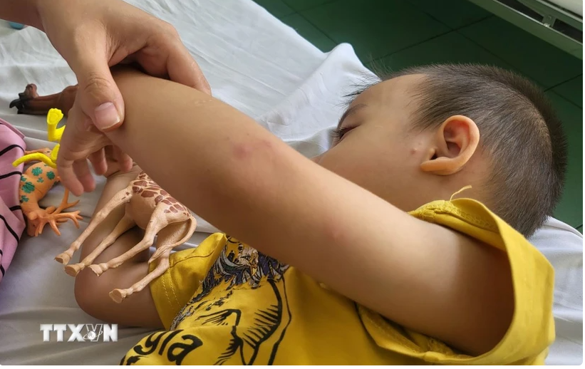 Một bệnh nhi mắc bệnh tay chân miệng đang điều trị nội trú tại Bệnh viện Nhi đồng 2 Thành phố Hồ Chí Minh. (Ảnh: Đinh Hằng/TTXVN)