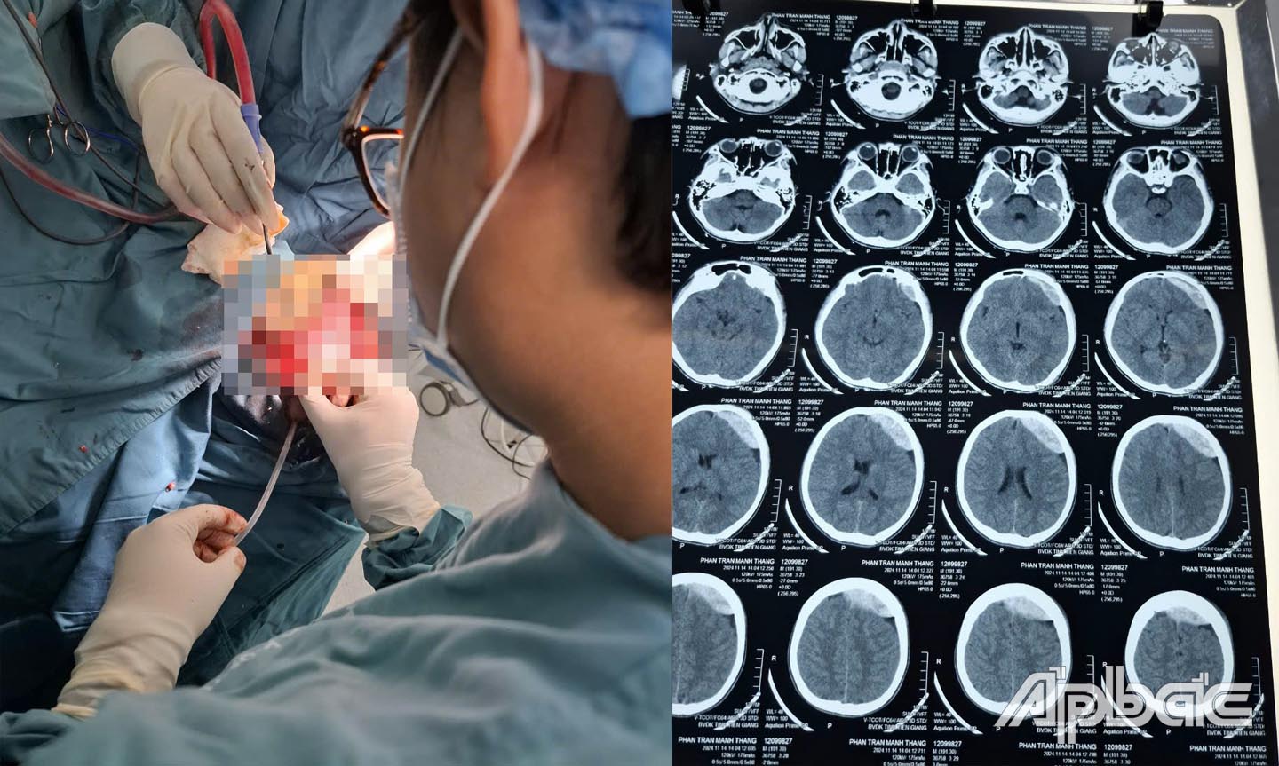 Một trường hợp cấp cứu chấn thương sọ não.