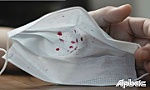 Bệnh nhiễm khuẩn gây ho ra máu ở Nga có đáng lo ngại?