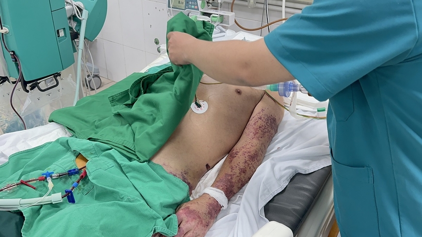 Ở thể sốc nhiễm khuẩn, bệnh nhân mắc liên cầu khuẩn lợn thường có phát ban xuất huyết thành từng đám lan tỏa kèm theo rối loạn đông máu nội mạch rải rác dễ tiến triển nhanh thành suy đa phủ tạng, tỷ lệ tử vong từ 5% tới 20%, nếu khỏi thì thời gian hồi phục thường kéo dài. Ảnh: suckhoedoisong.vn